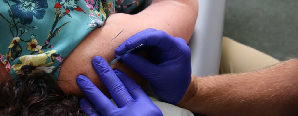 Dry-needling-Renue-Physical-Therapy-mid-Michigan