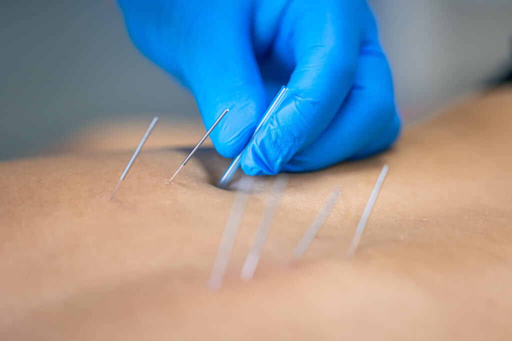 The Role of Dry Needling in Post-Surgery Rehabilitation